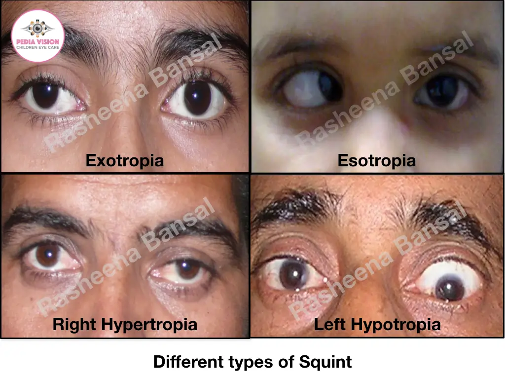 SQUINT SURGERY AND TREATMENT IN DELHI